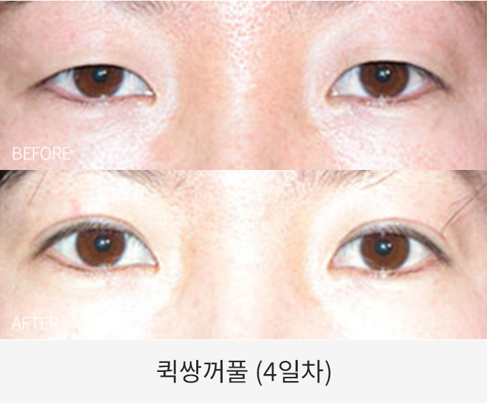 퀵쌍꺼풀