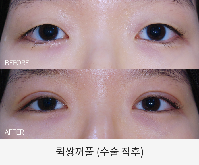 퀵쌍꺼풀
