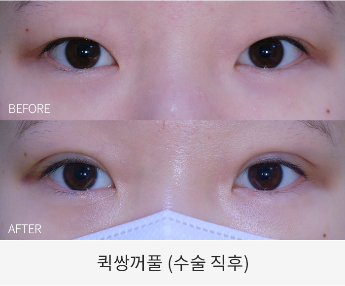 퀵쌍꺼풀