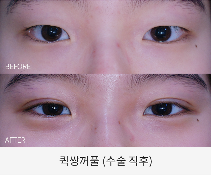 퀵쌍꺼풀