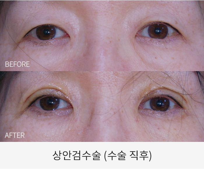상안검