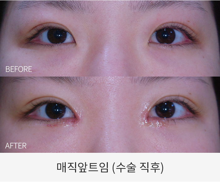 매직앞트임