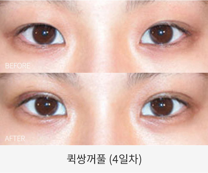 퀵쌍꺼풀
