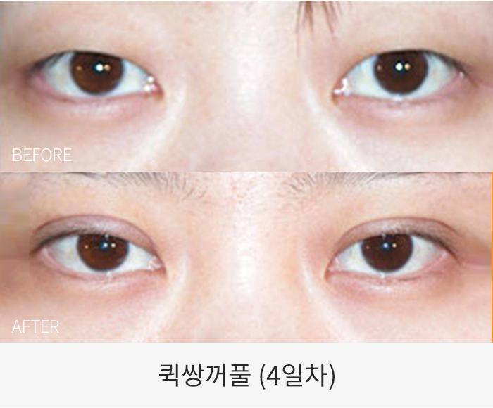 퀵쌍꺼풀